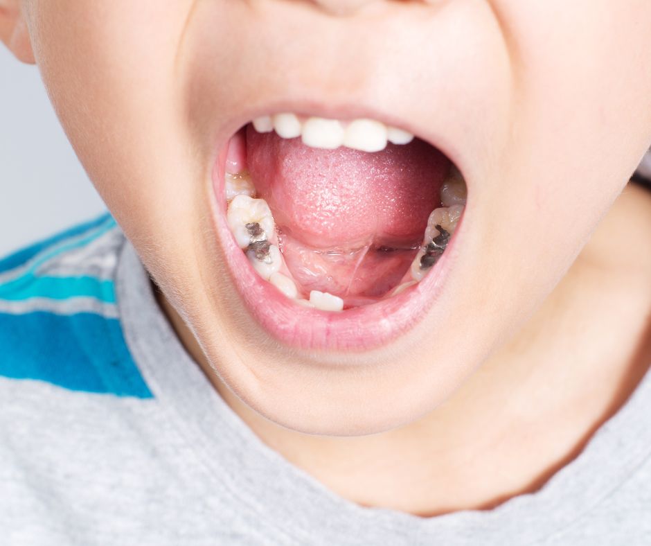 Dental Fillings That Are Great For Kids - Kids World Pediatric Dentistry